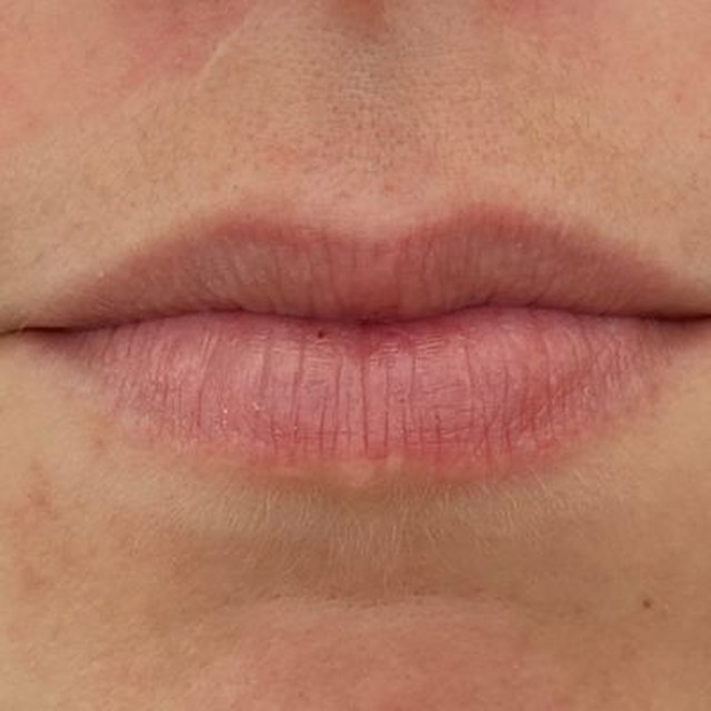 Lip filler before
