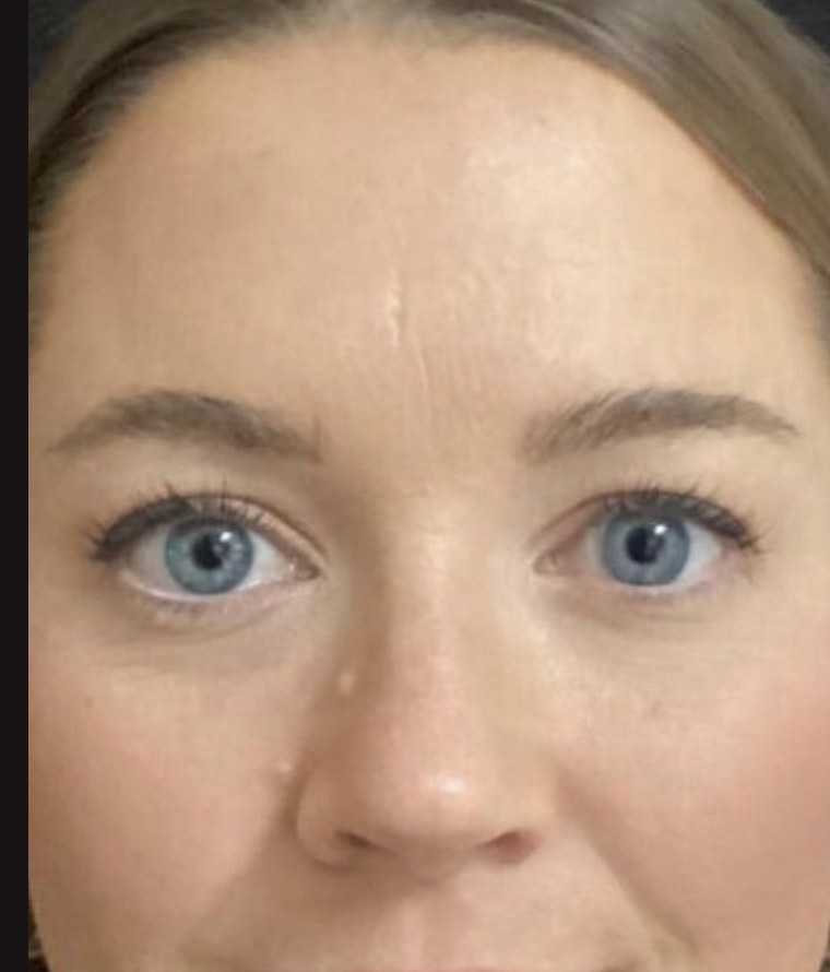 Forehead lines, 30 days after treatment