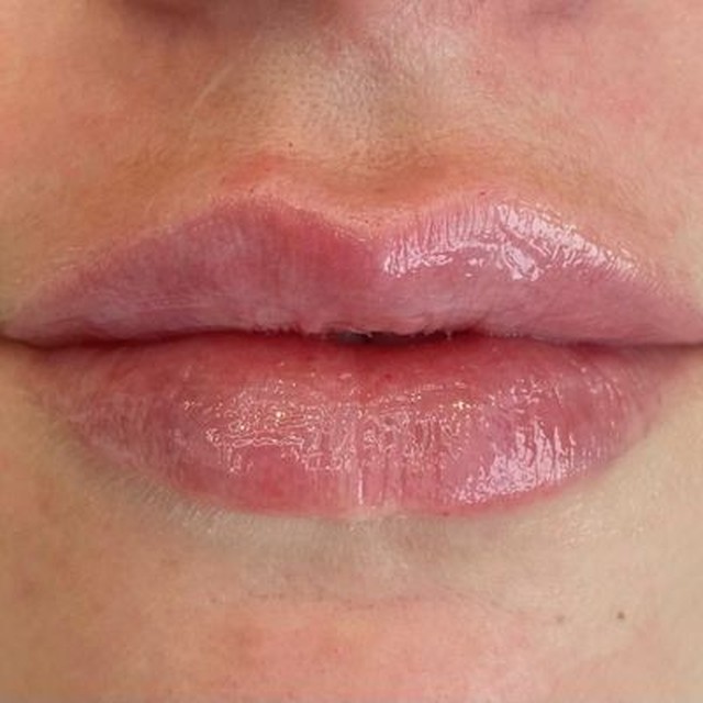 Lip filler after