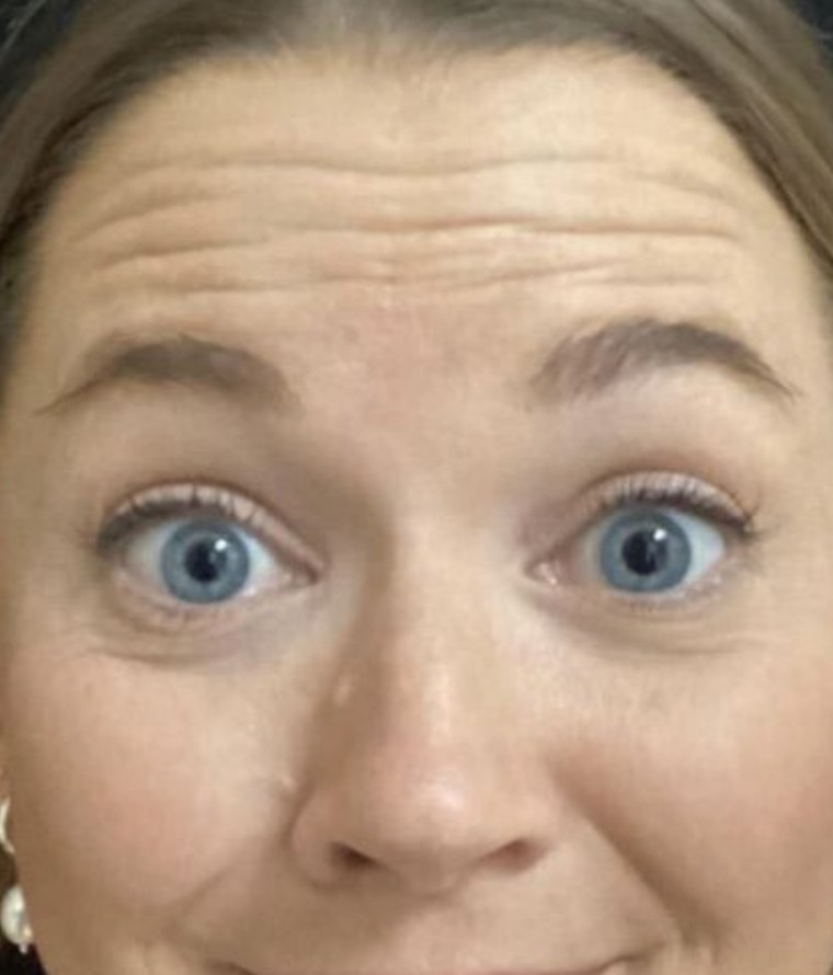 Forehead lines, before treatment